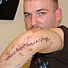 The stitches after my nerve surgery. by Seeley in Members Gallery